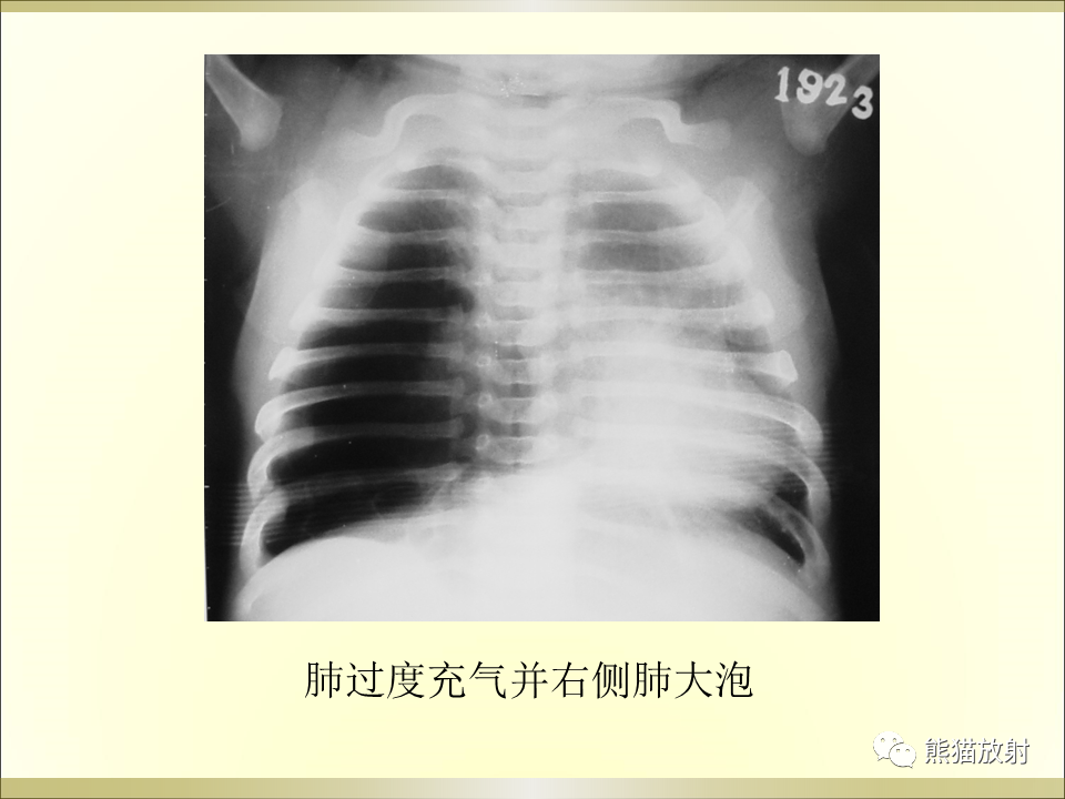 影像PPT - 【PPT】小儿肺炎的影像学诊断-28