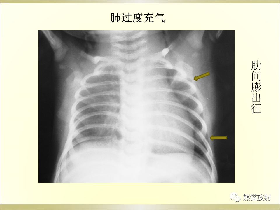 影像PPT - 【PPT】小儿肺炎的影像学诊断-27
