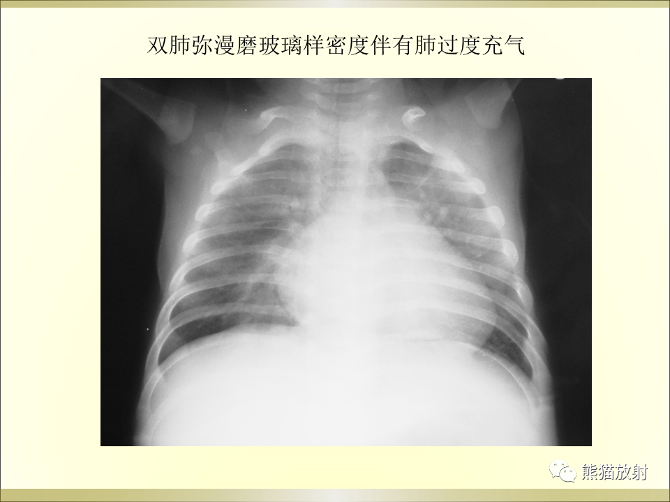 影像PPT - 【PPT】小儿肺炎的影像学诊断-25