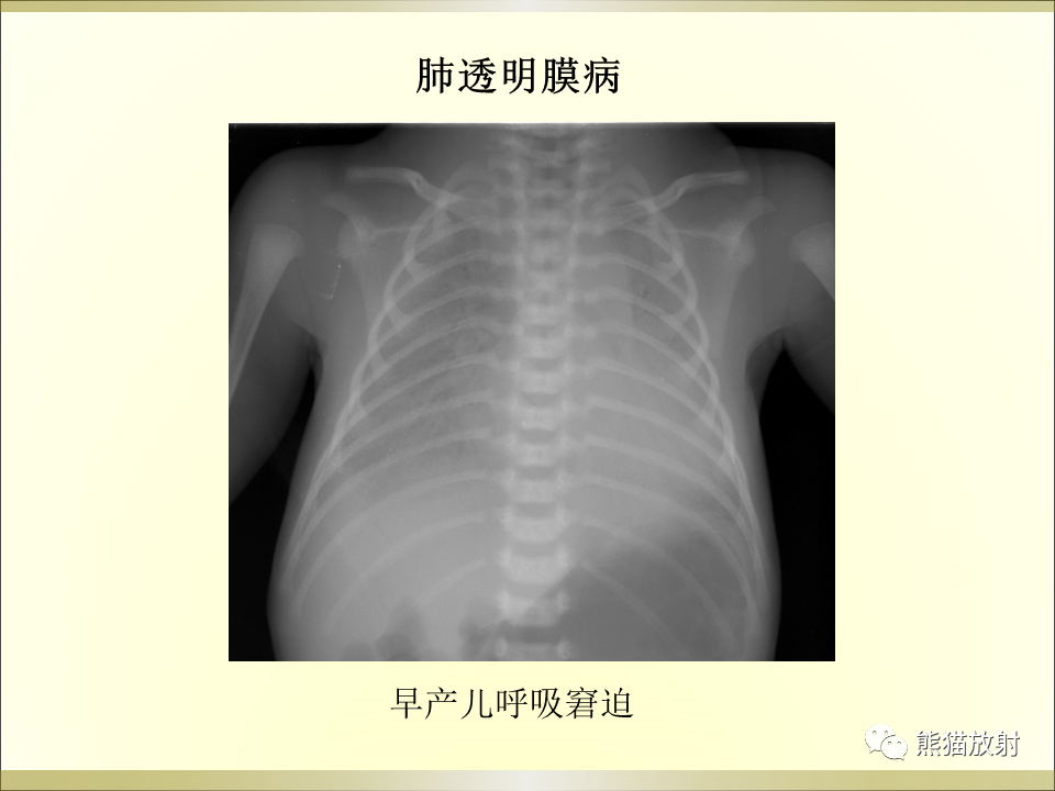 影像PPT - 【PPT】小儿肺炎的影像学诊断-32