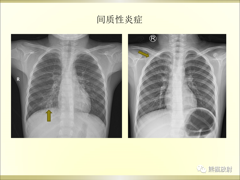 影像PPT - 【PPT】小儿肺炎的影像学诊断-35