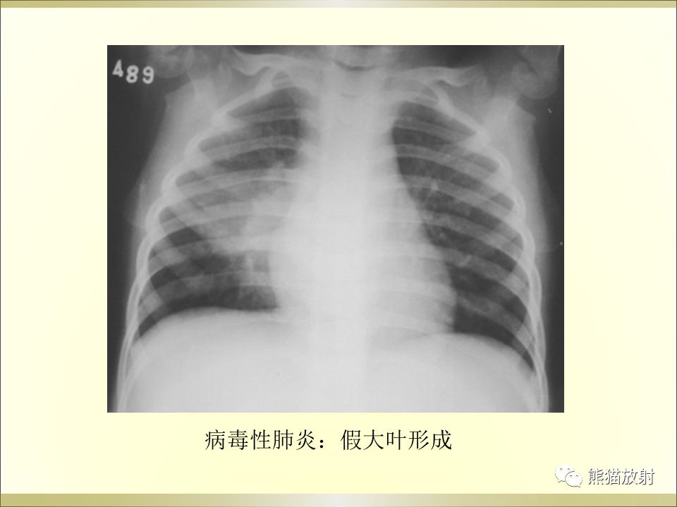 影像PPT - 【PPT】小儿肺炎的影像学诊断-36