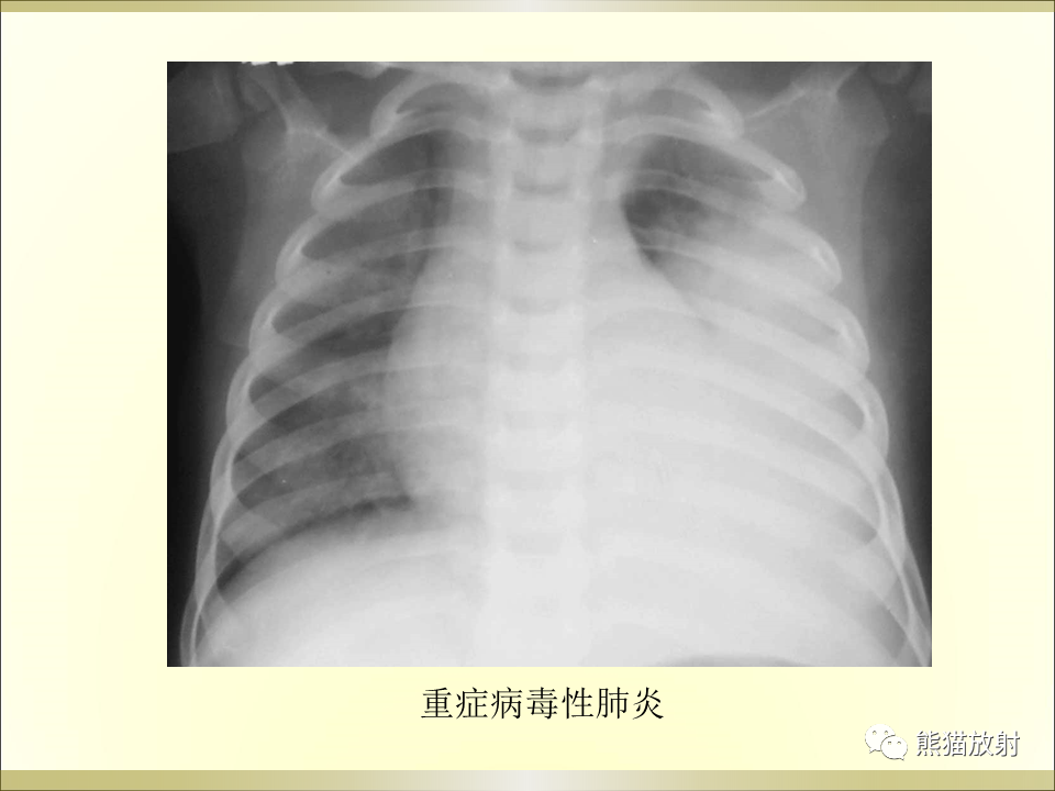 影像PPT - 【PPT】小儿肺炎的影像学诊断-37