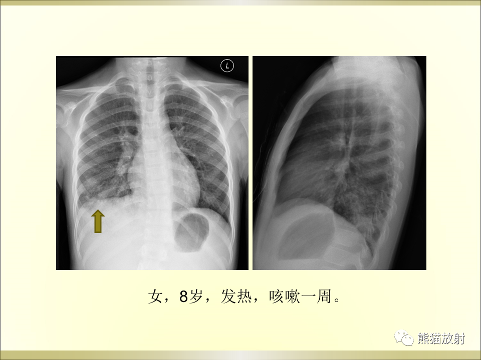 影像PPT - 【PPT】小儿肺炎的影像学诊断-42