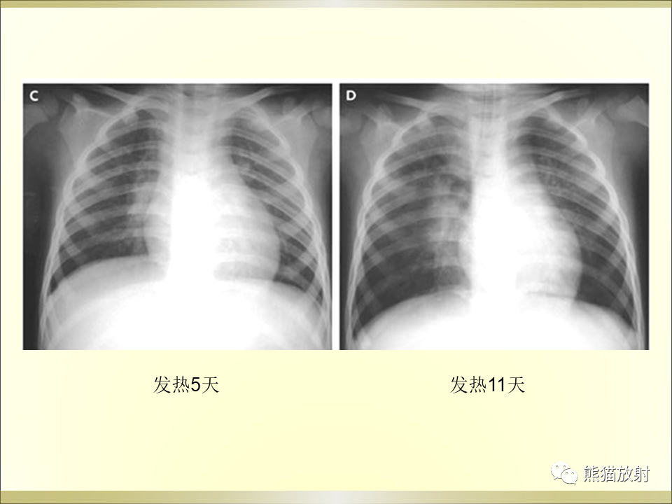 影像PPT - 【PPT】小儿肺炎的影像学诊断-41