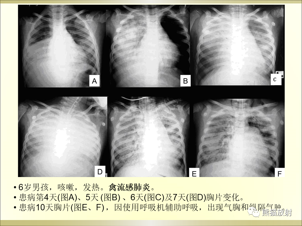 影像PPT - 【PPT】小儿肺炎的影像学诊断-44