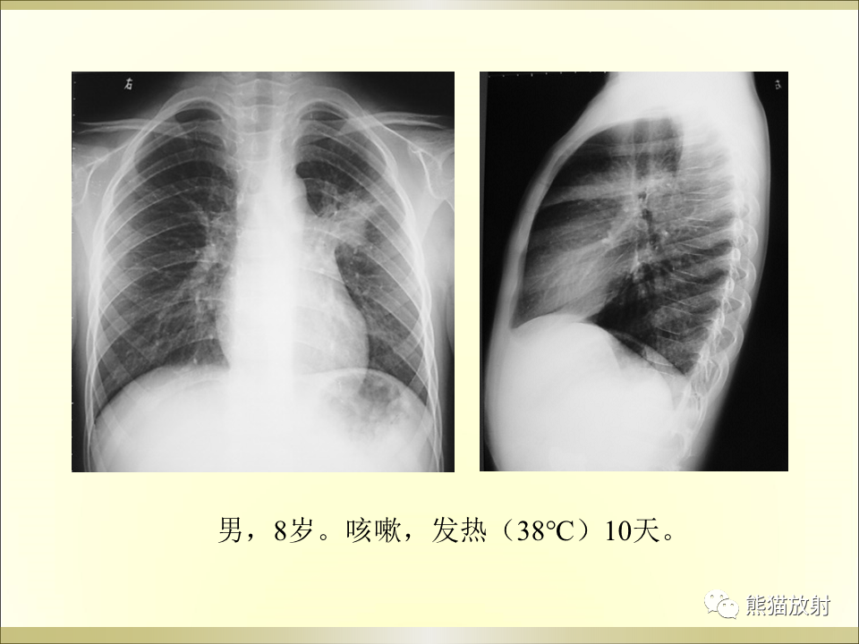 影像PPT - 【PPT】小儿肺炎的影像学诊断-49