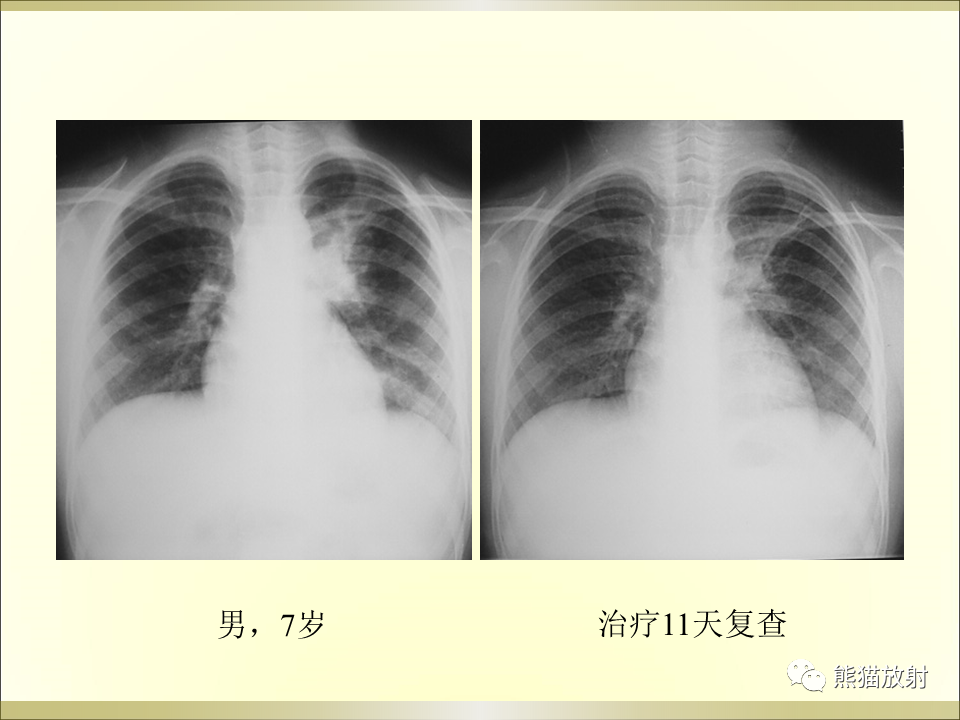 影像PPT - 【PPT】小儿肺炎的影像学诊断-50