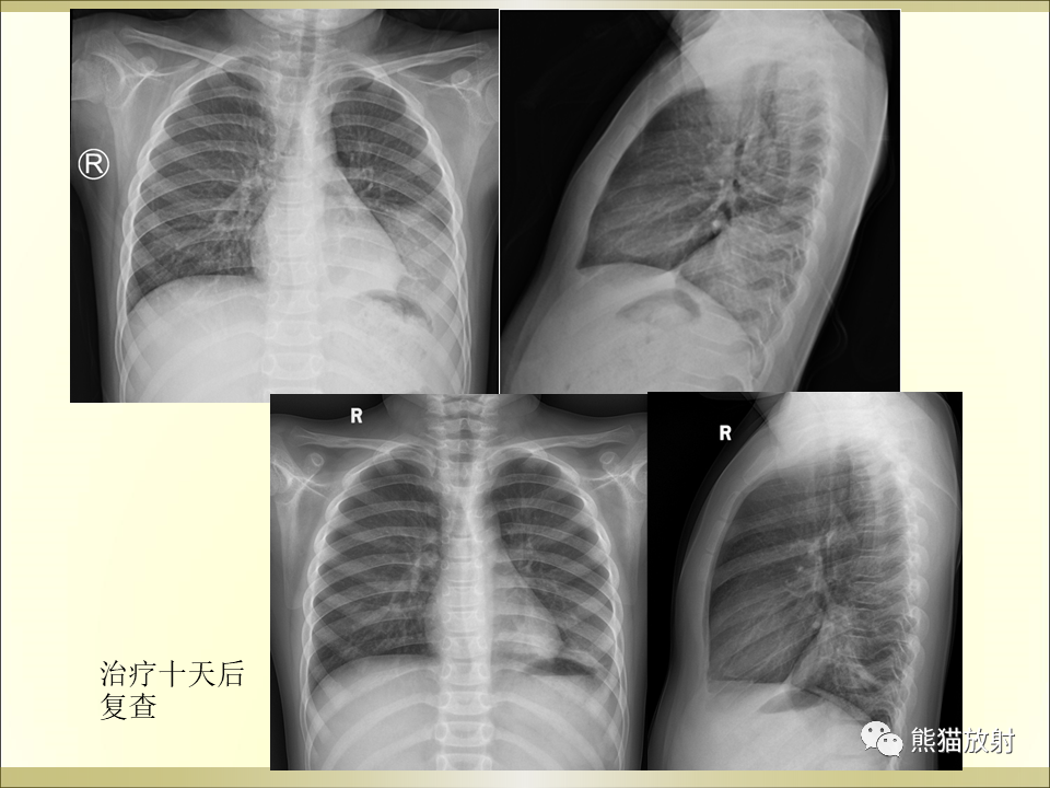 影像PPT - 【PPT】小儿肺炎的影像学诊断-51