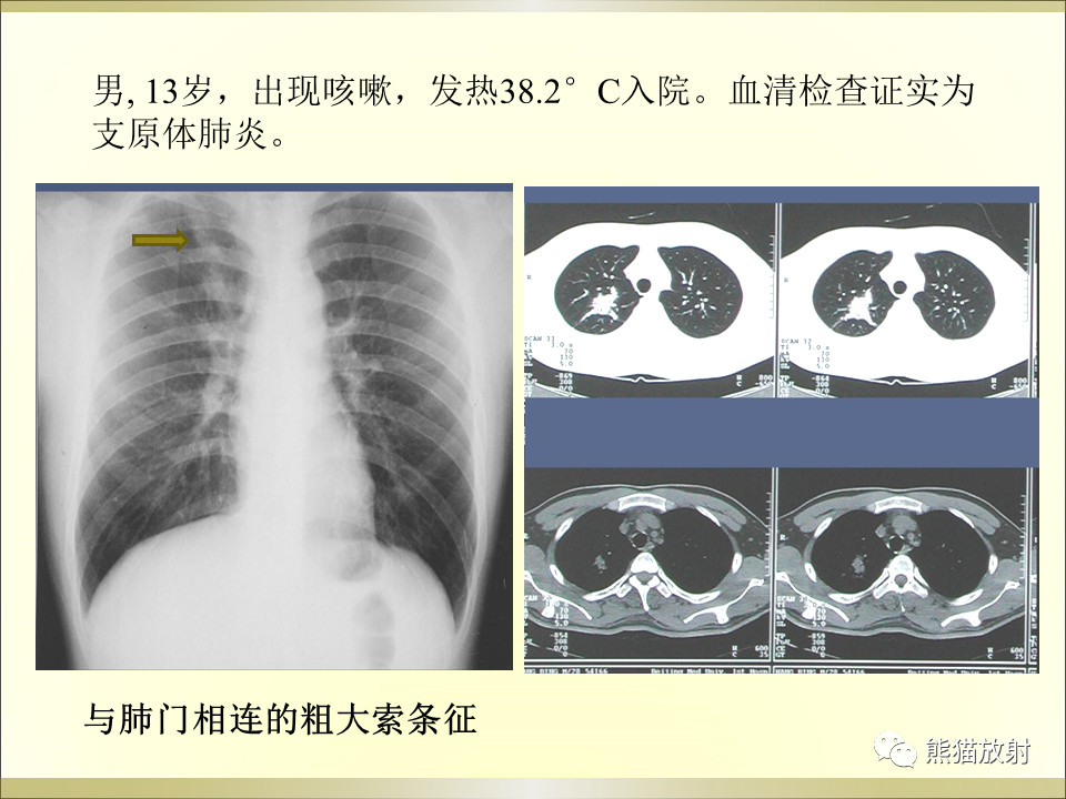 影像PPT - 【PPT】小儿肺炎的影像学诊断-54