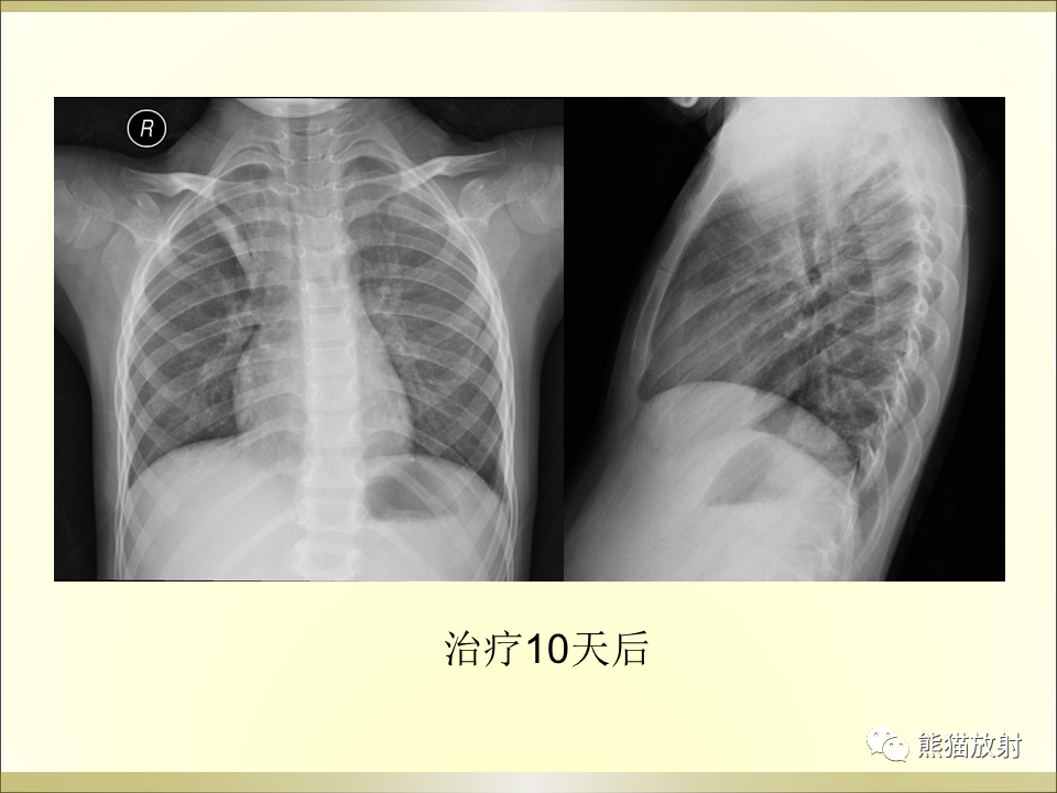 影像PPT - 【PPT】小儿肺炎的影像学诊断-53