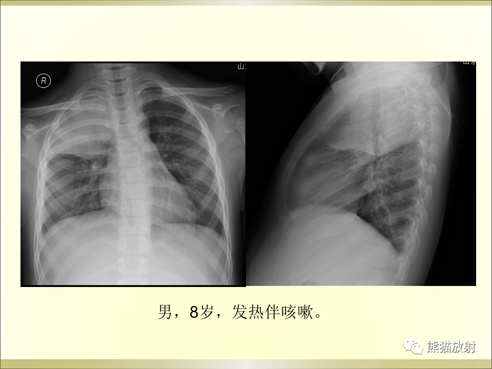 影像PPT - 【PPT】小儿肺炎的影像学诊断-57