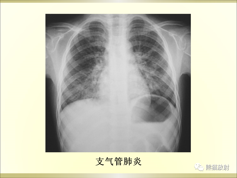 影像PPT - 【PPT】小儿肺炎的影像学诊断-59