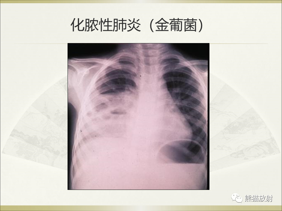 影像PPT - 【PPT】小儿肺炎的影像学诊断-62