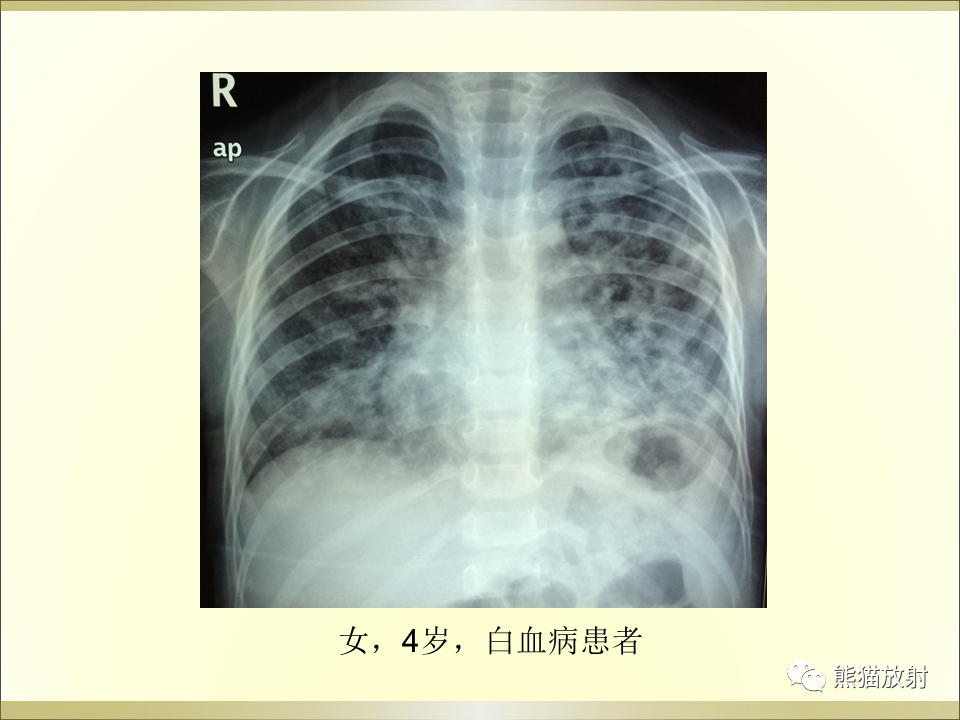 影像PPT - 【PPT】小儿肺炎的影像学诊断-67