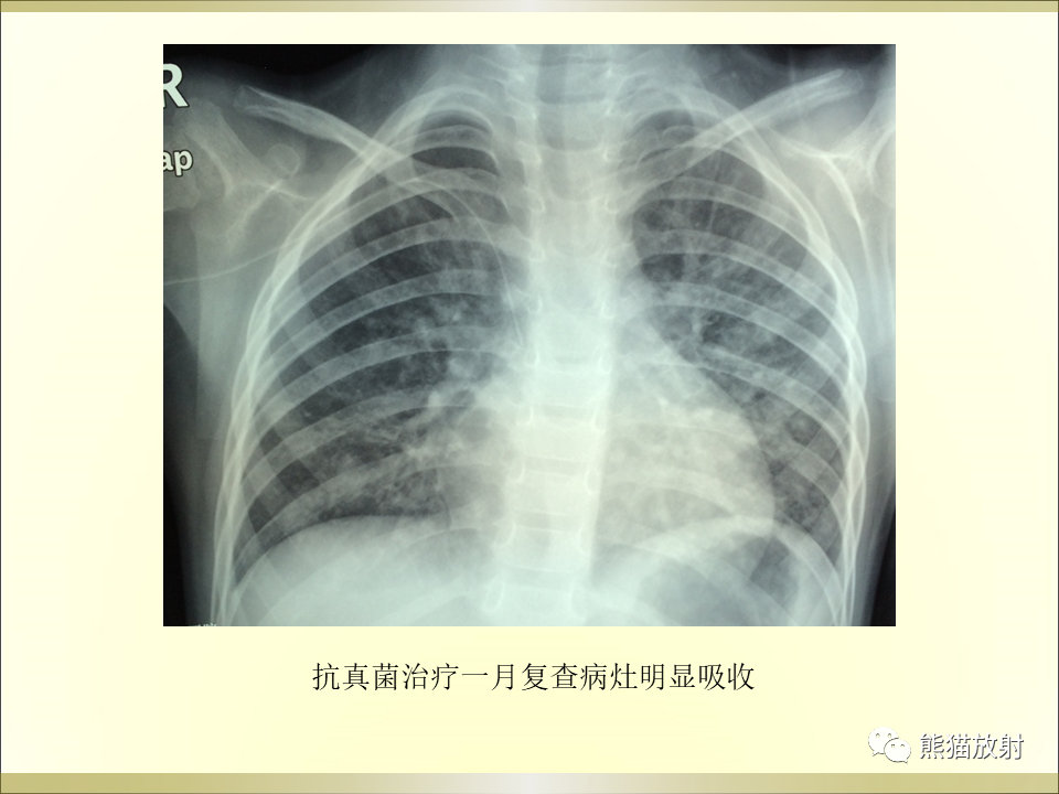 影像PPT - 【PPT】小儿肺炎的影像学诊断-69