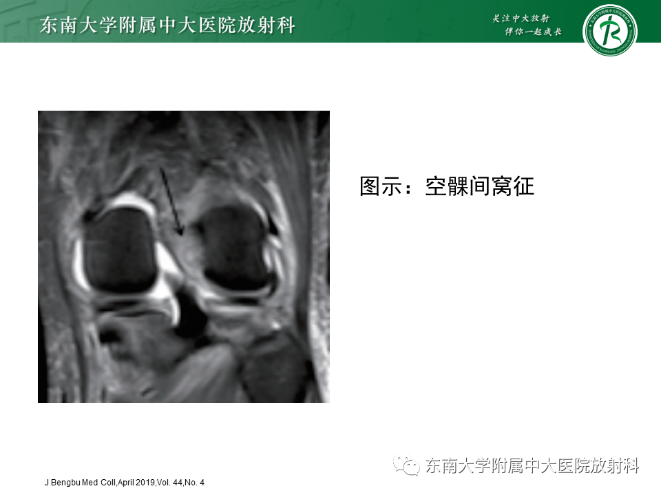 影像PPT - 【PPT】膝关节前交叉韧带损伤-14