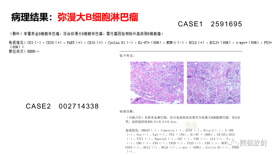 影像PPT - 【病例】原发性中枢神经系统淋巴瘤2例MR-27