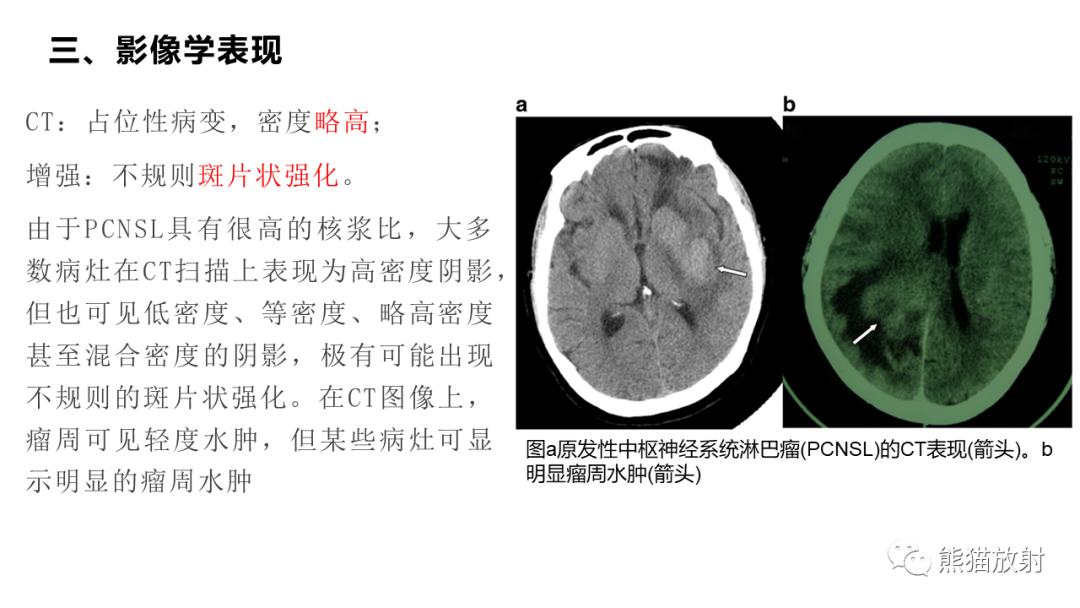 影像PPT - 【病例】原发性中枢神经系统淋巴瘤2例MR-31