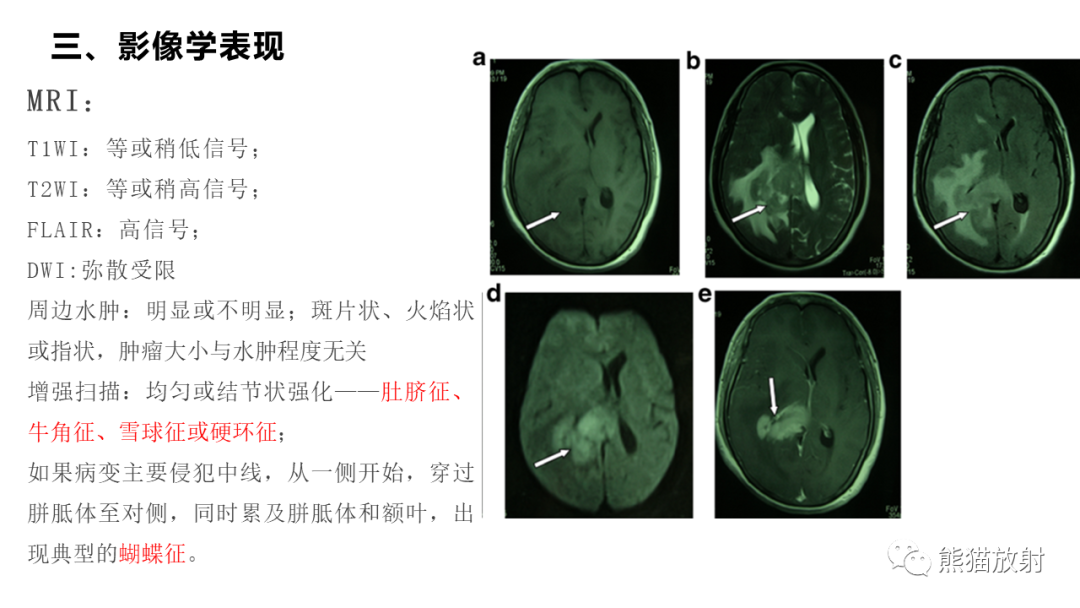 影像PPT - 【病例】原发性中枢神经系统淋巴瘤2例MR-32