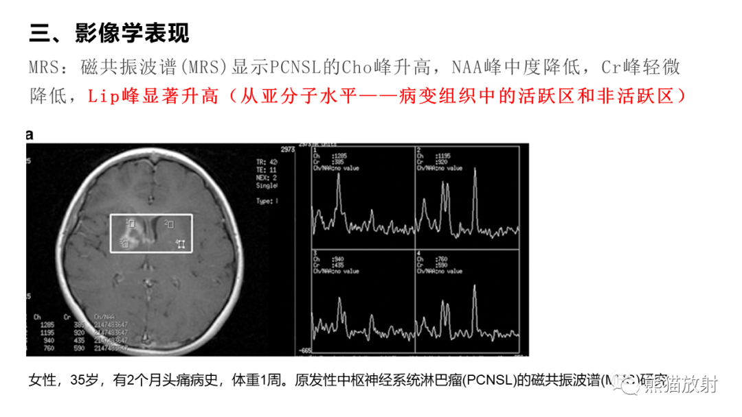 影像PPT - 【病例】原发性中枢神经系统淋巴瘤2例MR-34