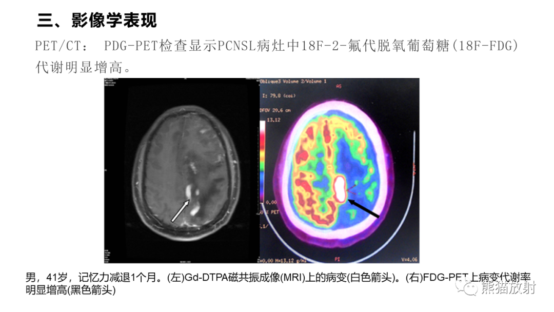 影像PPT - 【病例】原发性中枢神经系统淋巴瘤2例MR-35