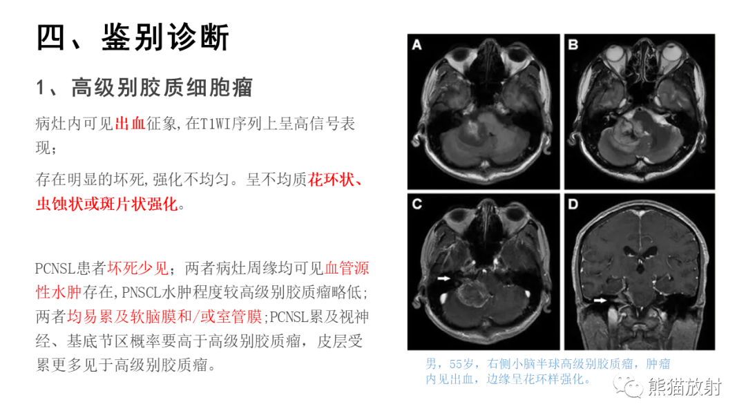 影像PPT - 【病例】原发性中枢神经系统淋巴瘤2例MR-36