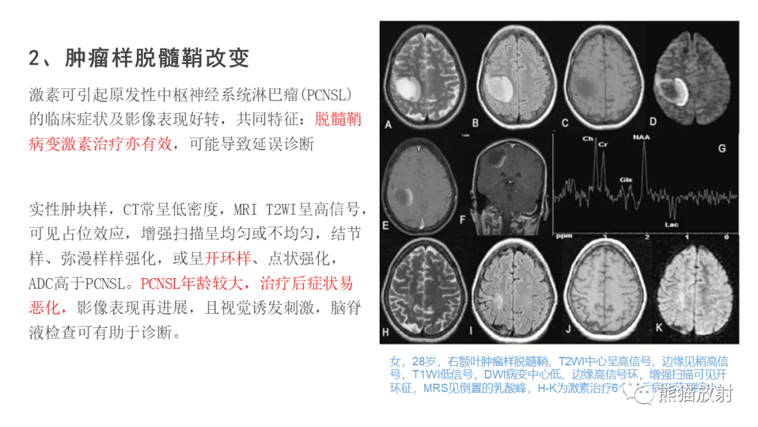 影像PPT - 【病例】原发性中枢神经系统淋巴瘤2例MR-37