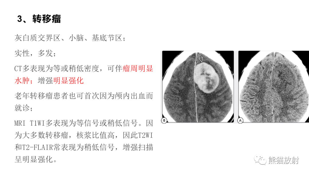 影像PPT - 【病例】原发性中枢神经系统淋巴瘤2例MR-38