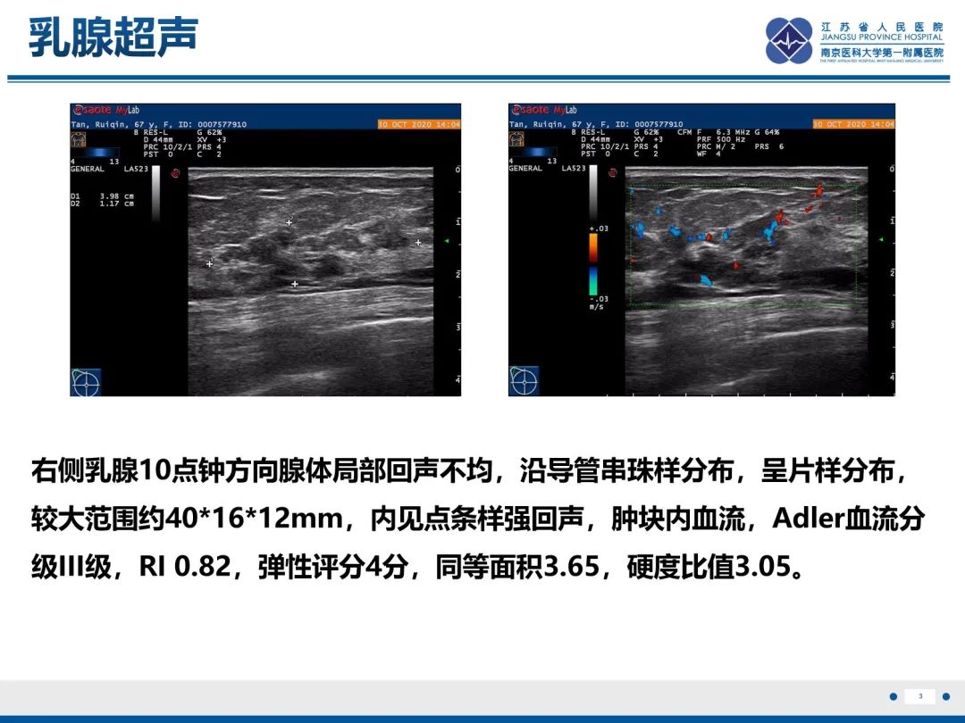 影像PPT - 【PPT】乳腺实性乳头状癌-4