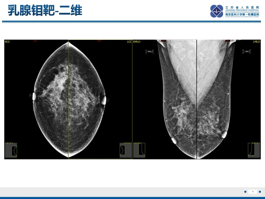 影像PPT - 【PPT】乳腺实性乳头状癌-5