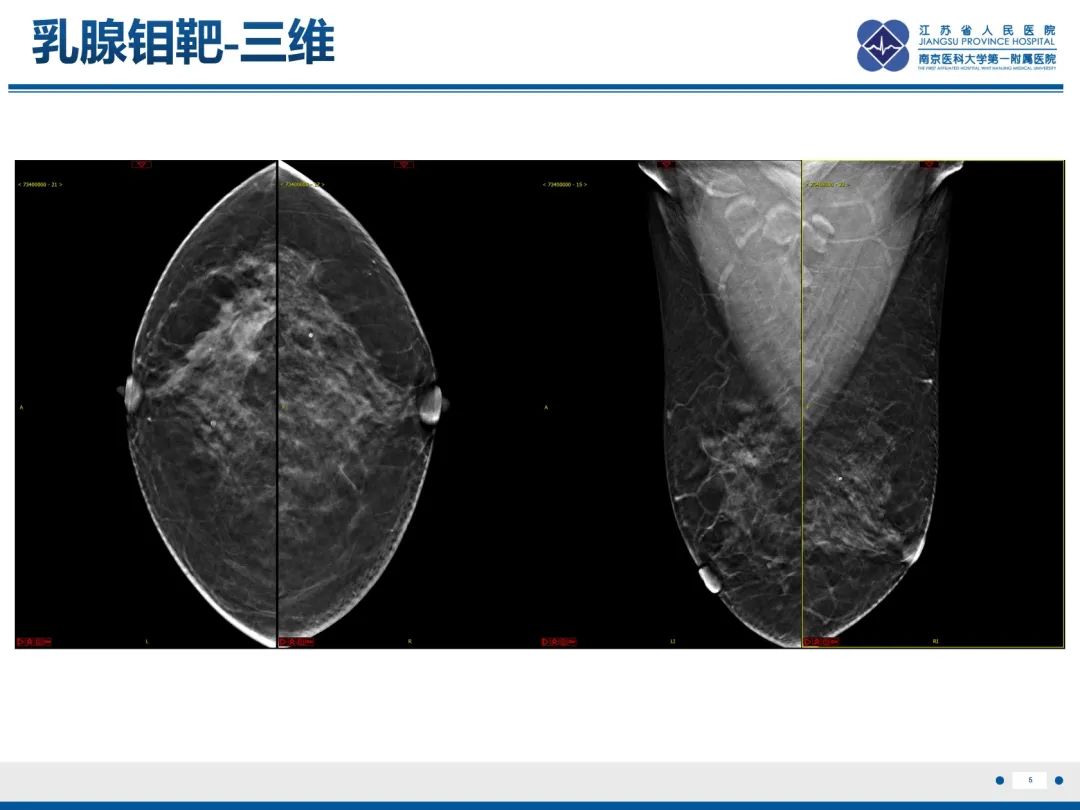 影像PPT - 【PPT】乳腺实性乳头状癌-6