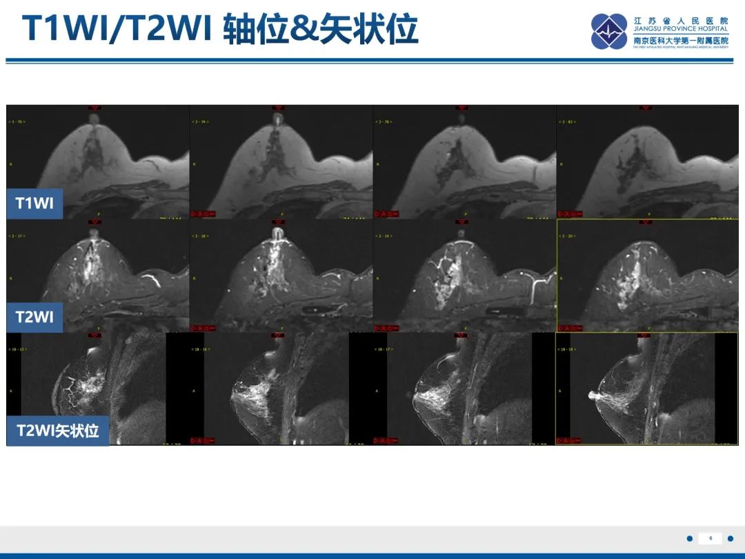 影像PPT - 【PPT】乳腺实性乳头状癌-7