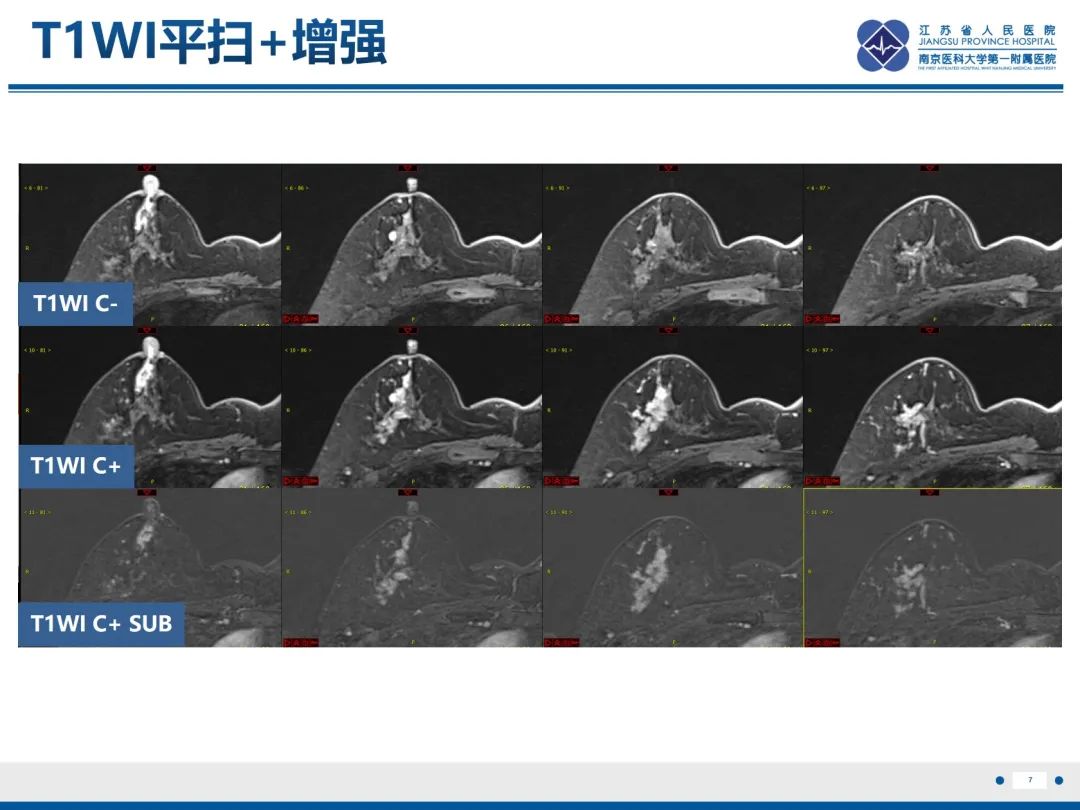 影像PPT - 【PPT】乳腺实性乳头状癌-8