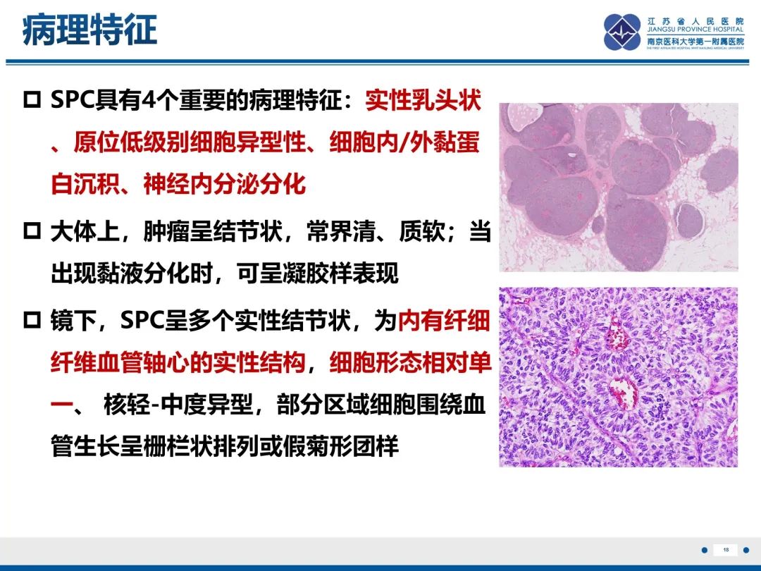 影像PPT - 【PPT】乳腺实性乳头状癌-19