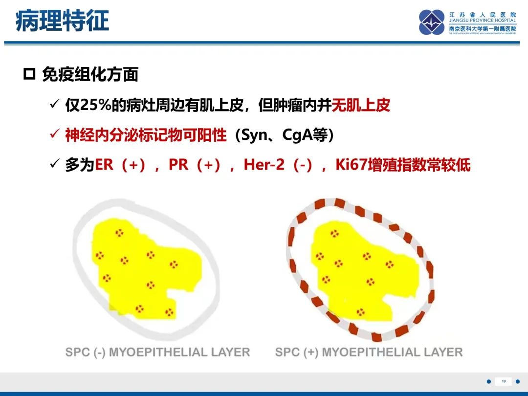 影像PPT - 【PPT】乳腺实性乳头状癌-20