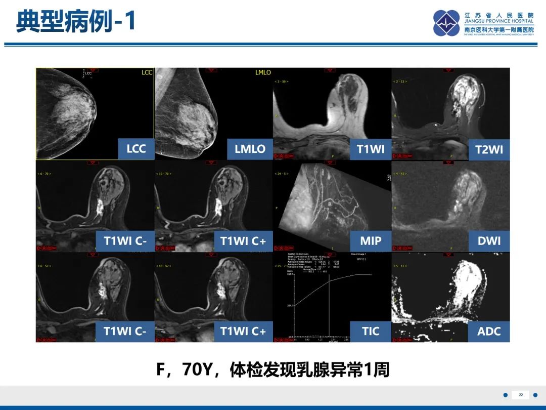影像PPT - 【PPT】乳腺实性乳头状癌-23