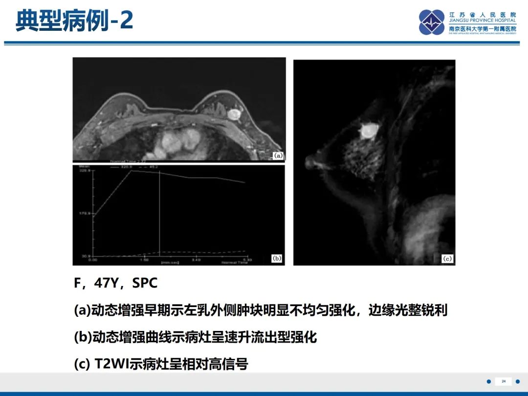 影像PPT - 【PPT】乳腺实性乳头状癌-25