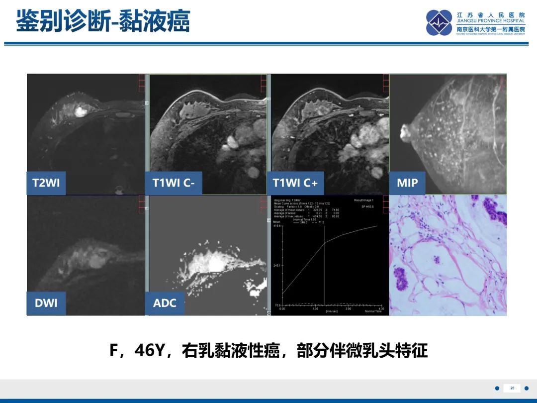 影像PPT - 【PPT】乳腺实性乳头状癌-29