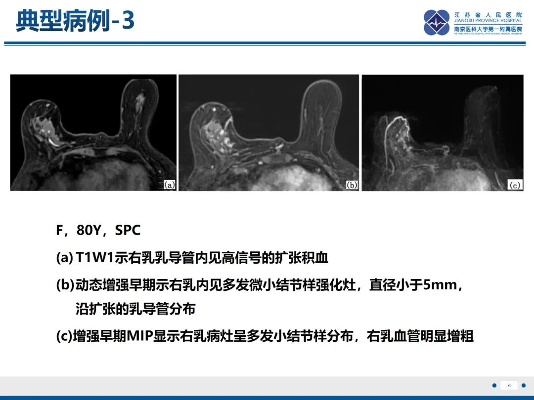 影像PPT - 【PPT】乳腺实性乳头状癌-26