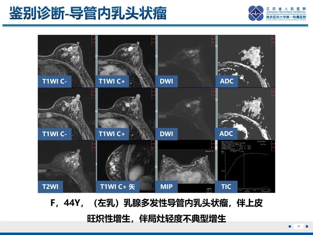 影像PPT - 【PPT】乳腺实性乳头状癌-33