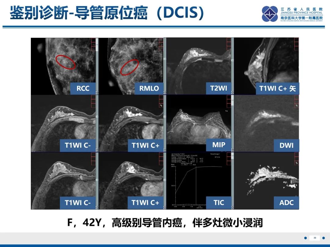 影像PPT - 【PPT】乳腺实性乳头状癌-31