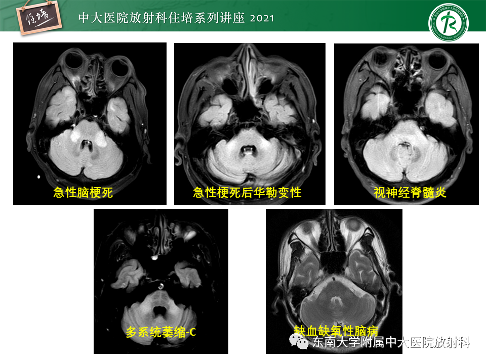 影像PPT - 【PPT】双侧桥臂磁共振异常信号的影像诊断思路-4