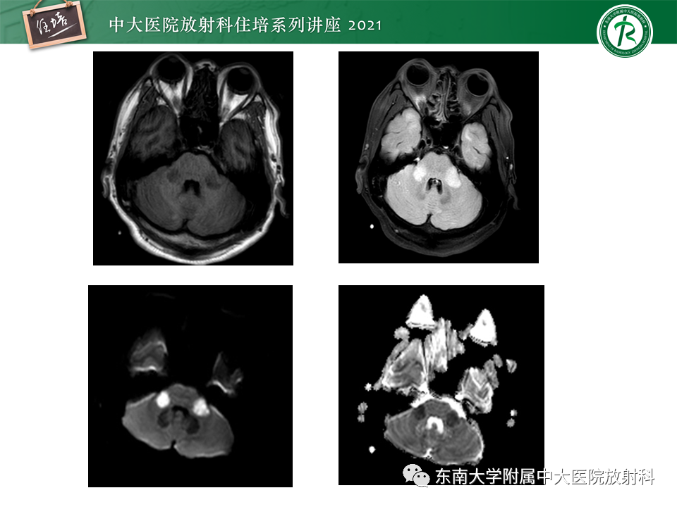 影像PPT - 【PPT】双侧桥臂磁共振异常信号的影像诊断思路-8