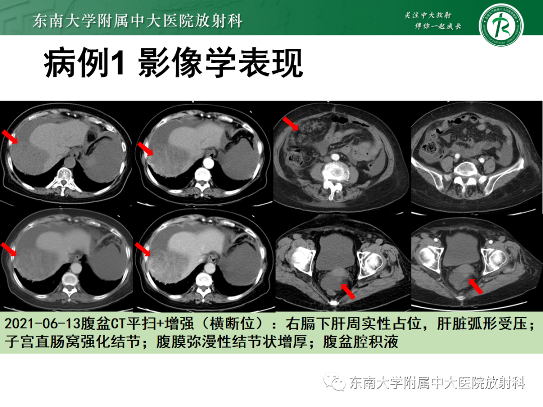 影像PPT - 【PPT】腹膜弥漫性病变-13 影像PPT - 【PPT】腹膜弥漫性病变-13