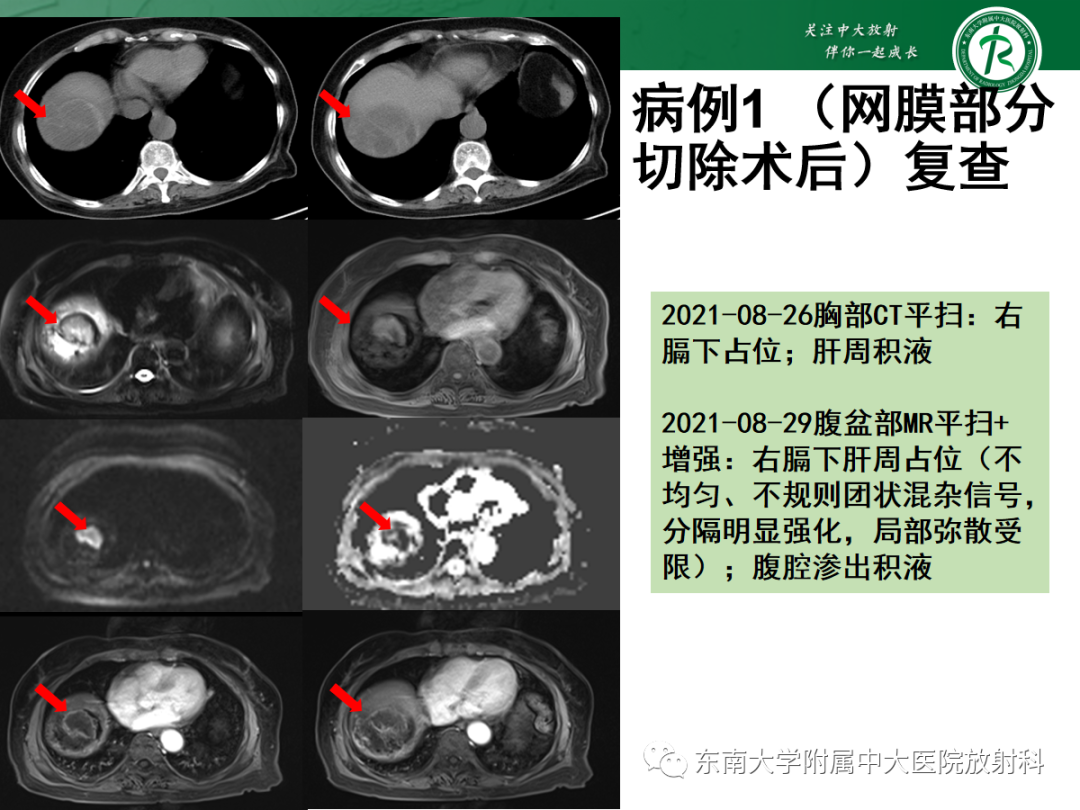 影像PPT - 【PPT】腹膜弥漫性病变-16 影像PPT - 【PPT】腹膜弥漫性病变-16
