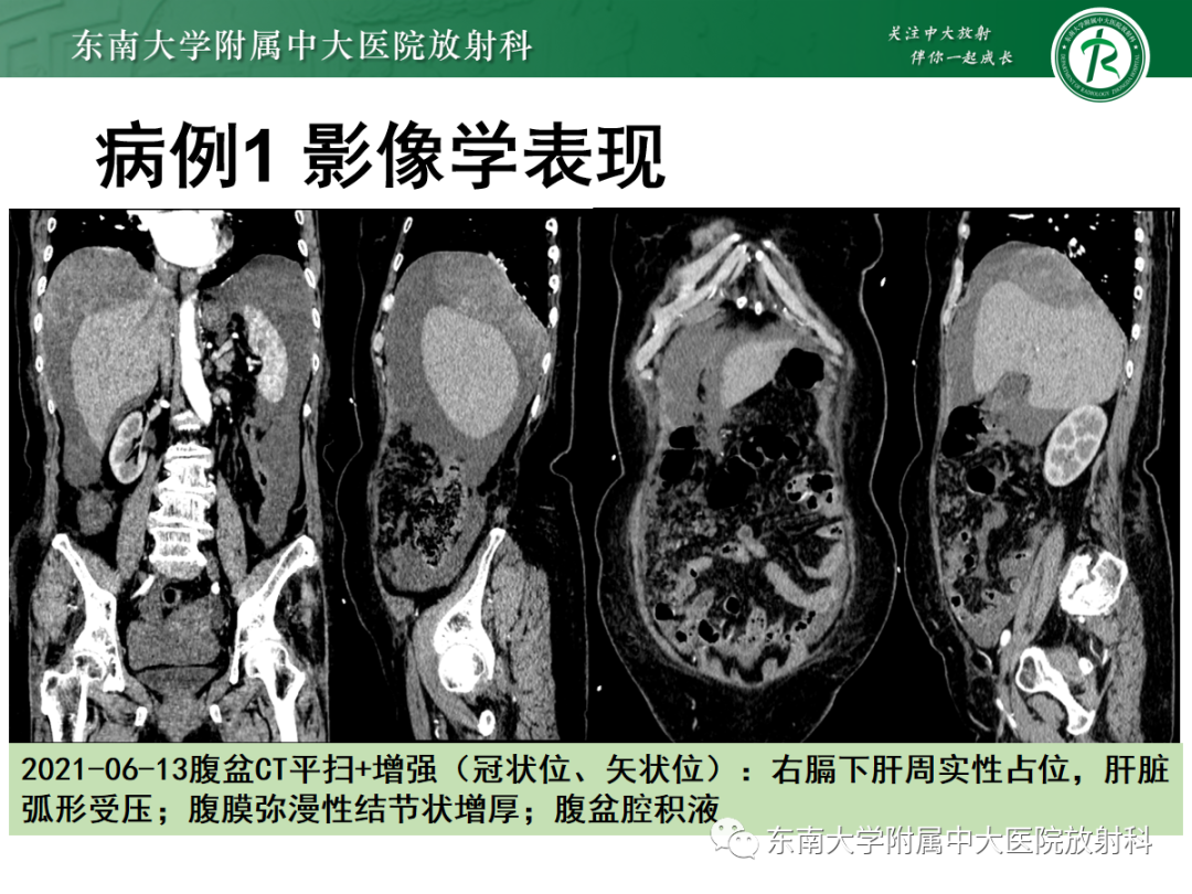 影像PPT - 【PPT】腹膜弥漫性病变-14 影像PPT - 【PPT】腹膜弥漫性病变-14