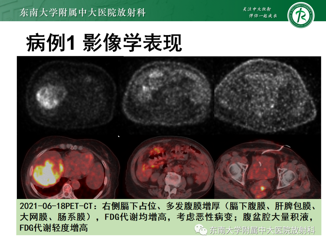 影像PPT - 【PPT】腹膜弥漫性病变-15 影像PPT - 【PPT】腹膜弥漫性病变-15