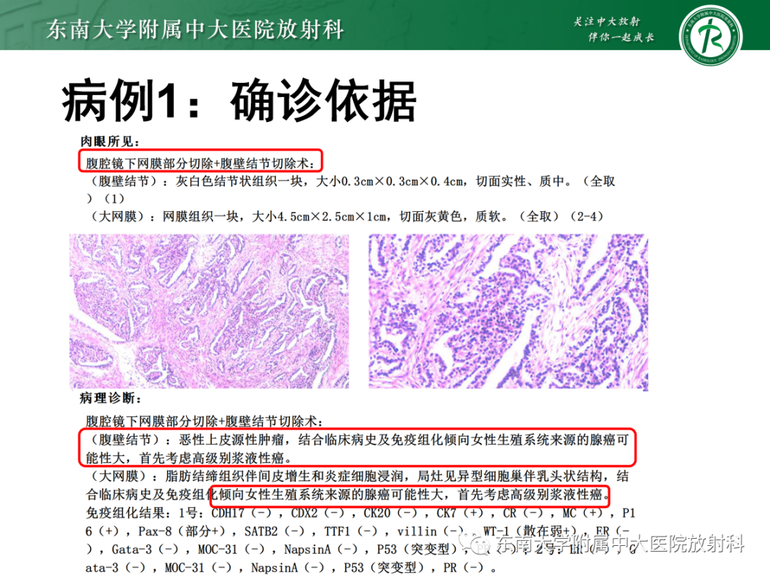 影像PPT - 【PPT】腹膜弥漫性病变-17 影像PPT - 【PPT】腹膜弥漫性病变-17