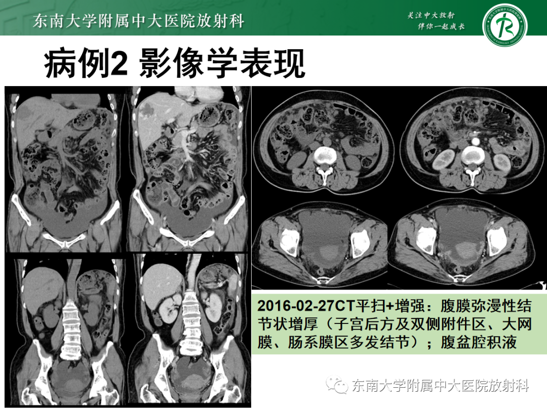 影像PPT - 【PPT】腹膜弥漫性病变-18 影像PPT - 【PPT】腹膜弥漫性病变-18